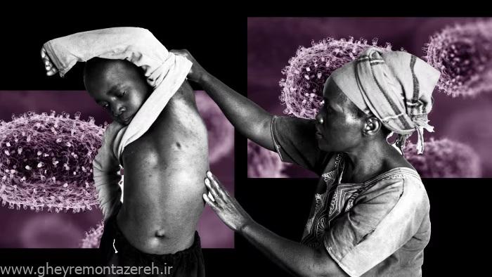 آبله میمون؛ خطری در کمین سلامت جهانی/ بیش از ۱۶ هزار مبتلا در بیش از ۷۵ کشور جهان/ آیا کار به قرنطینه و پاندمی میرسد؟ / مرگ و میر در کودکان بیشتر است