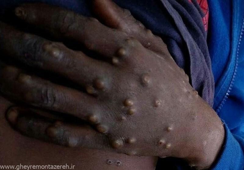 هشدار جدی / پاکستان از نخستین مورد ابتلا به «آبله میمونی» خبر داد