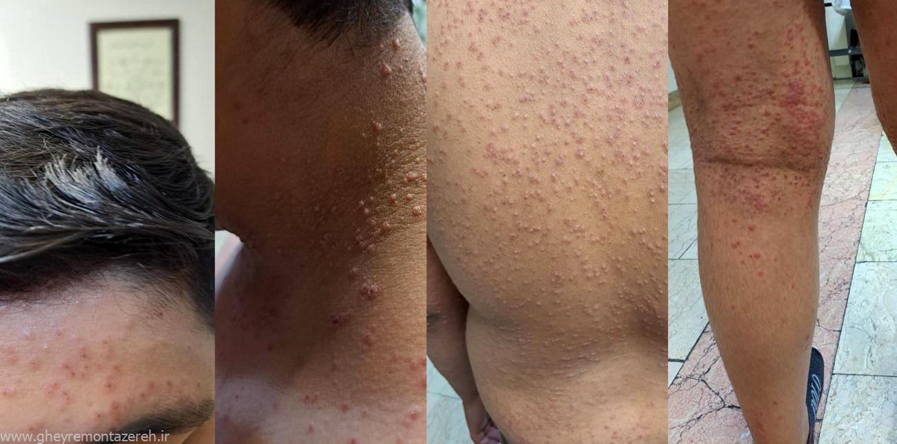 رئیس مرکز بیماریهای عفونی وزارت بهداشت: مورد ابتلا به آبله میمون در ایران شناسایی نشده / عکس منتشر شده مشخص نیست مربوط به کدام منطقه است