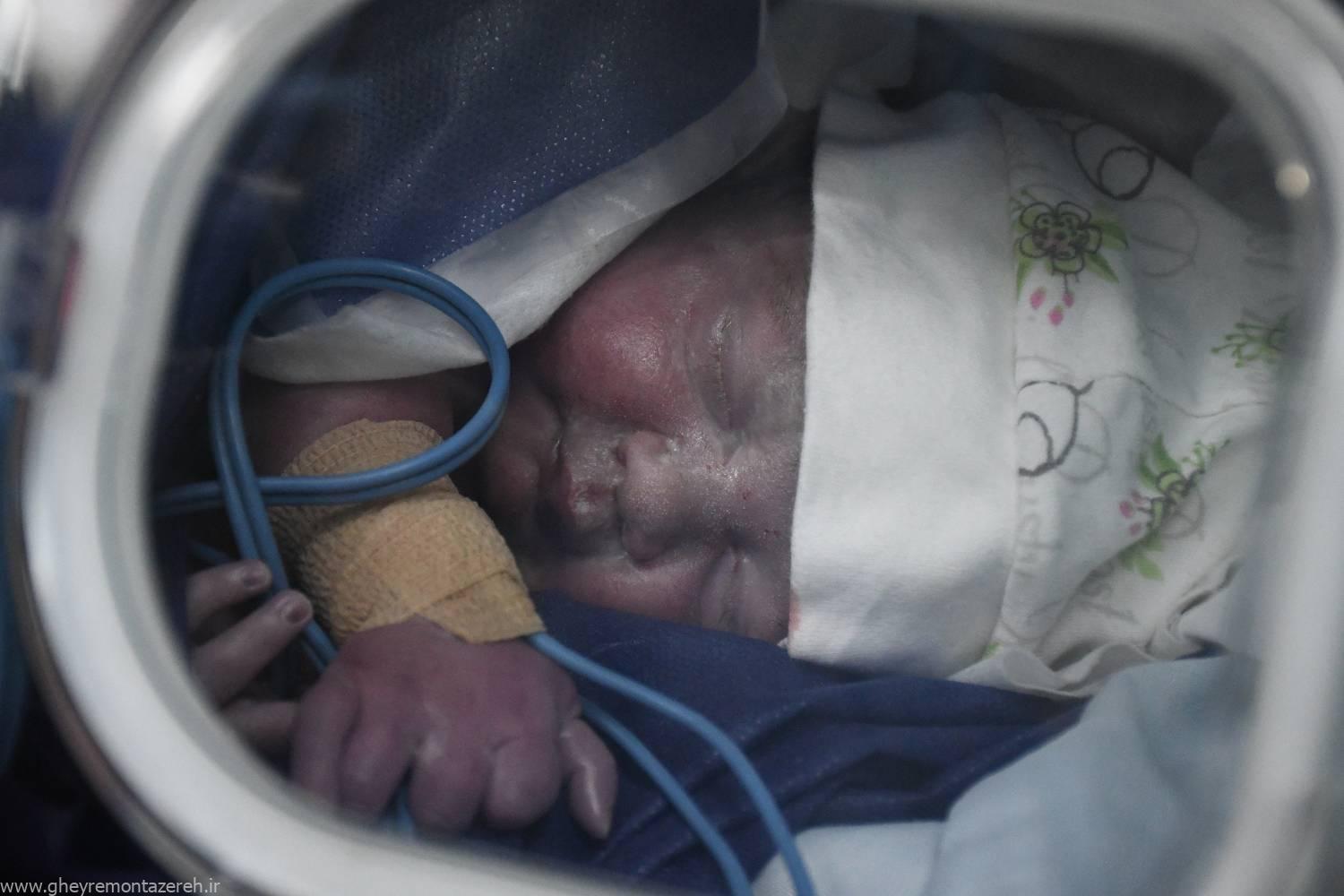 تولد نوزادی در رشت از مادری پیوند عضو شده