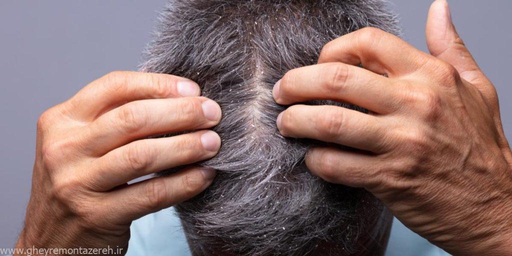 شوره سر دارید؟ شاید دلیلش کمبود این ویتامین باشد