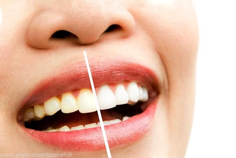 ۵ اشتباهی که سبب پوسیدگی دندان میشود